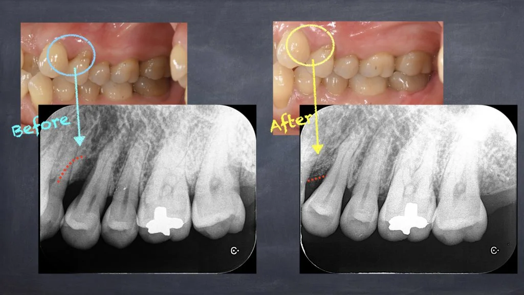 低侵襲歯周病治療