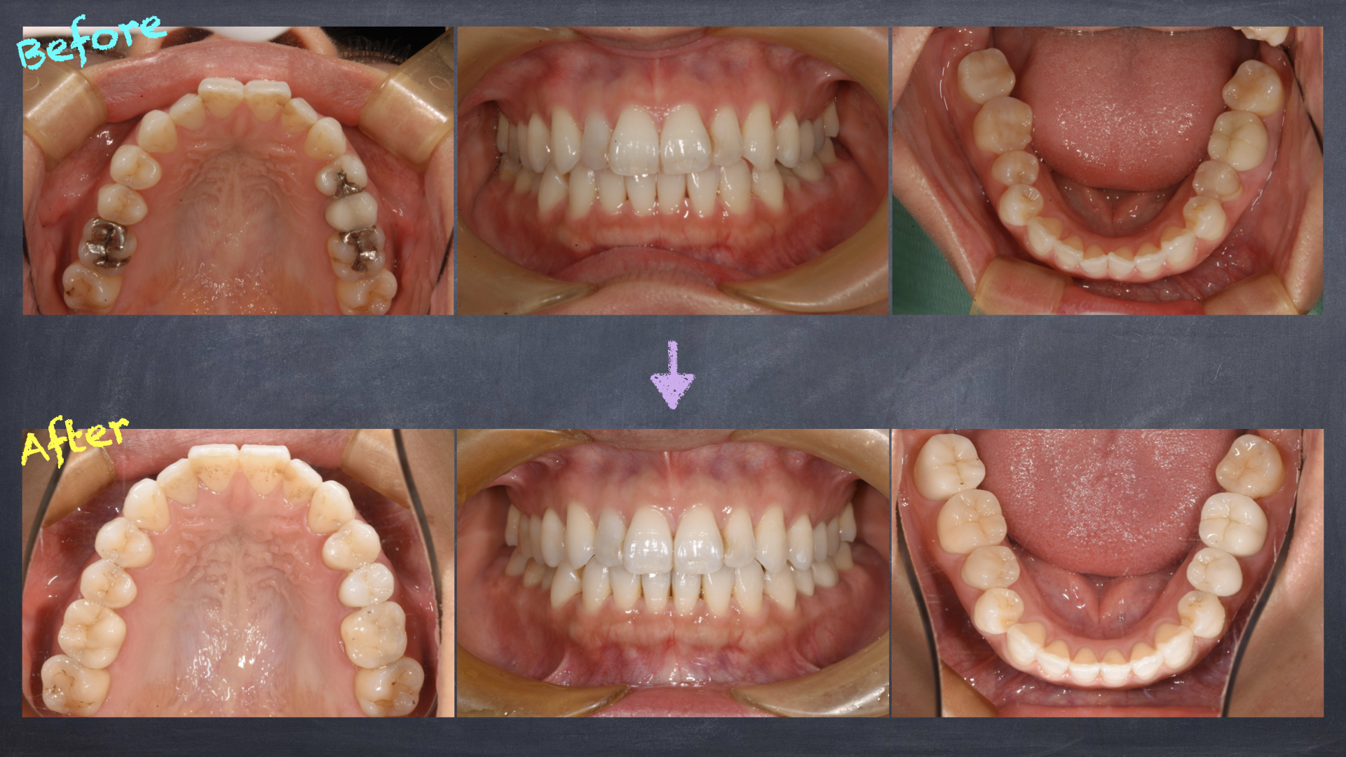 前歯の矯正治療と臼歯のセラミック修復
