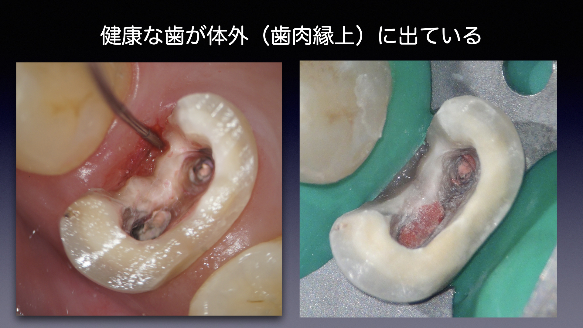 深い虫歯の治療：再発を防ぐための矯正的アプローチ