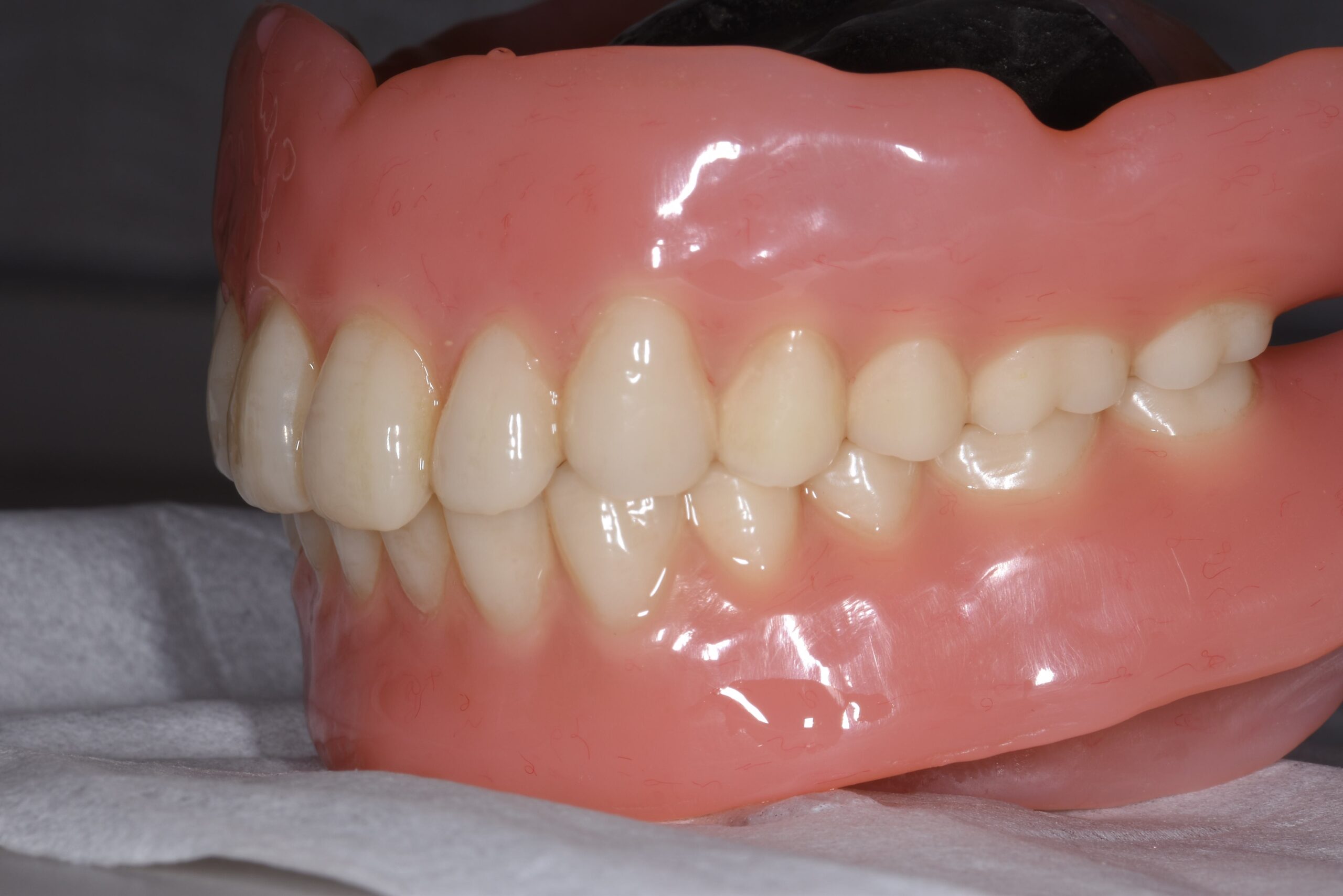 総義歯（総入れ歯）治療