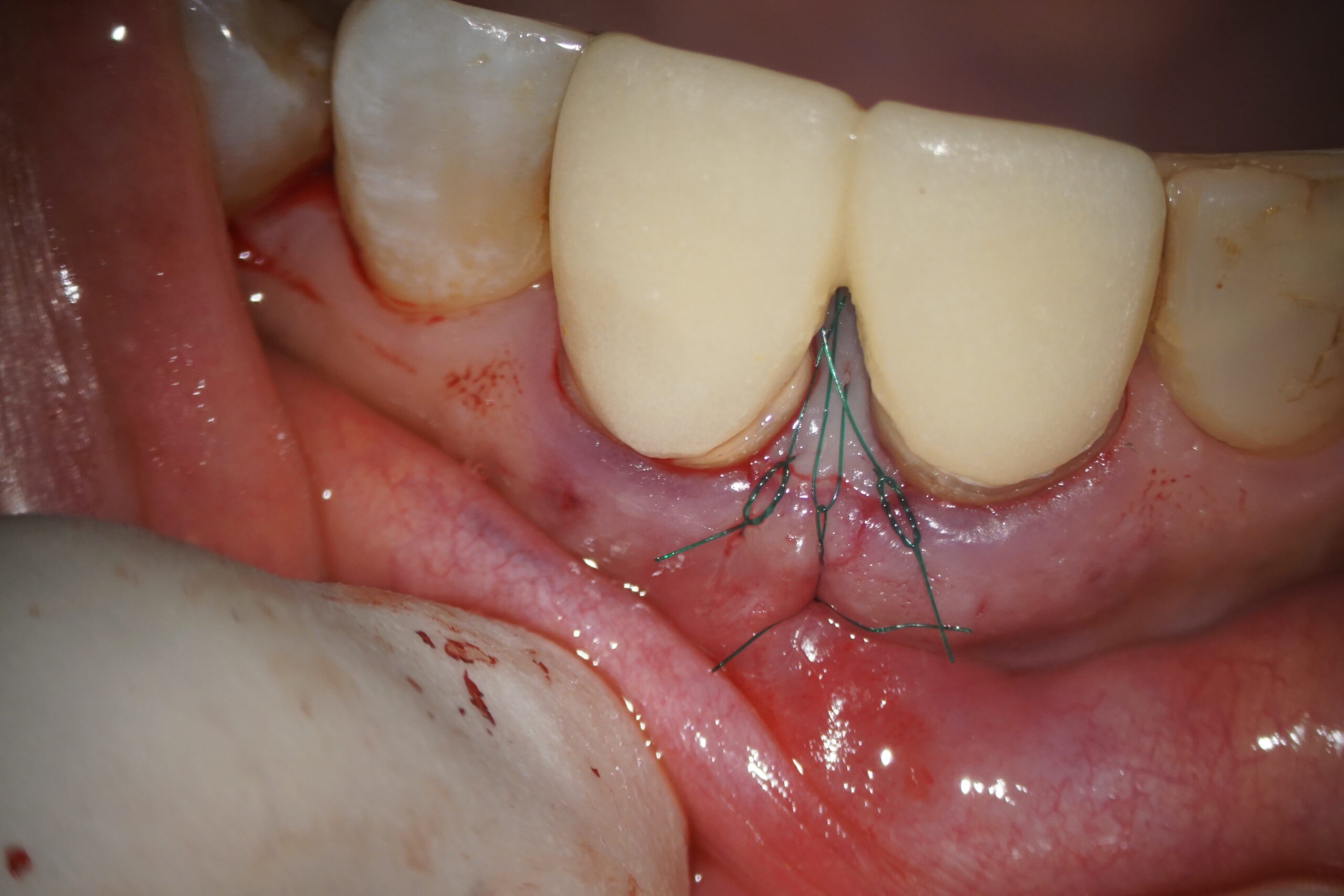 前歯の歯周組織再生療法