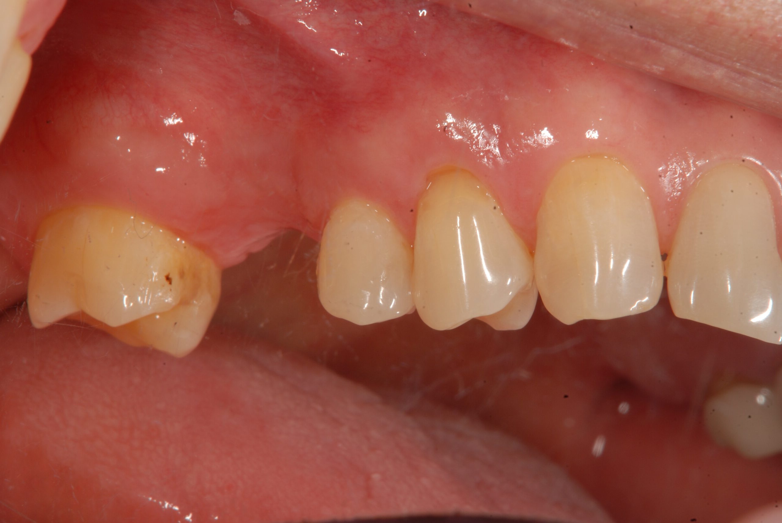 骨や歯茎が不足している部分へのインプラント治療例（GBRとFGGの応用）