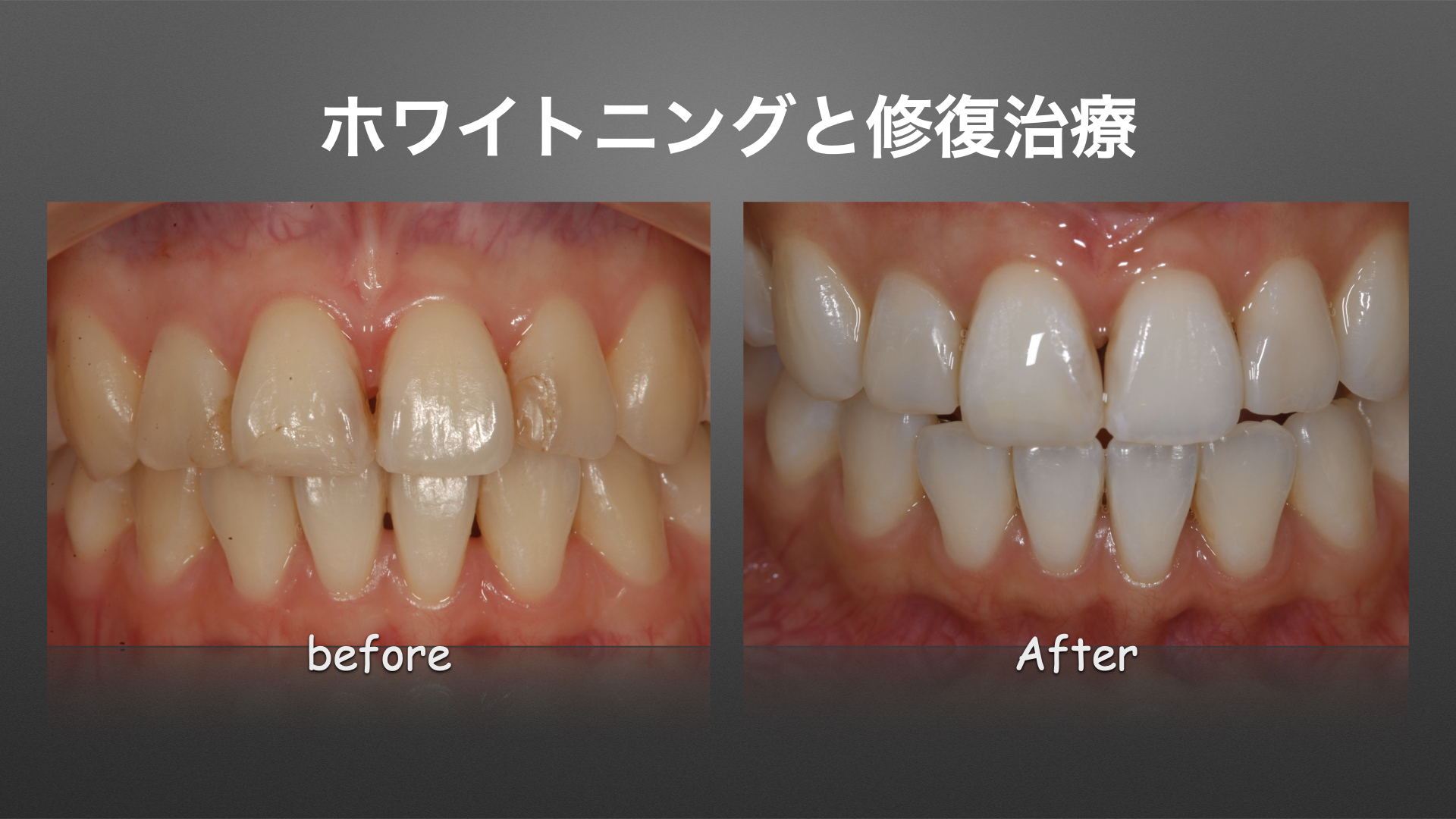 ホワイトニングと前歯の修復治療の流れ
