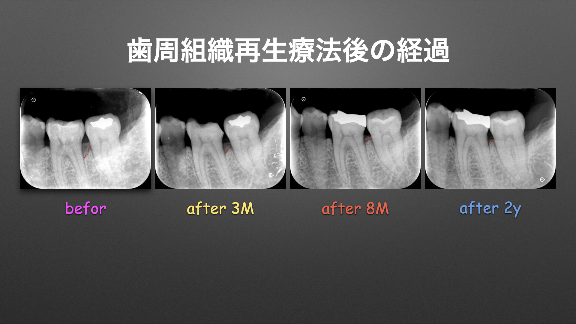 歯周組織再生療法の術後経過