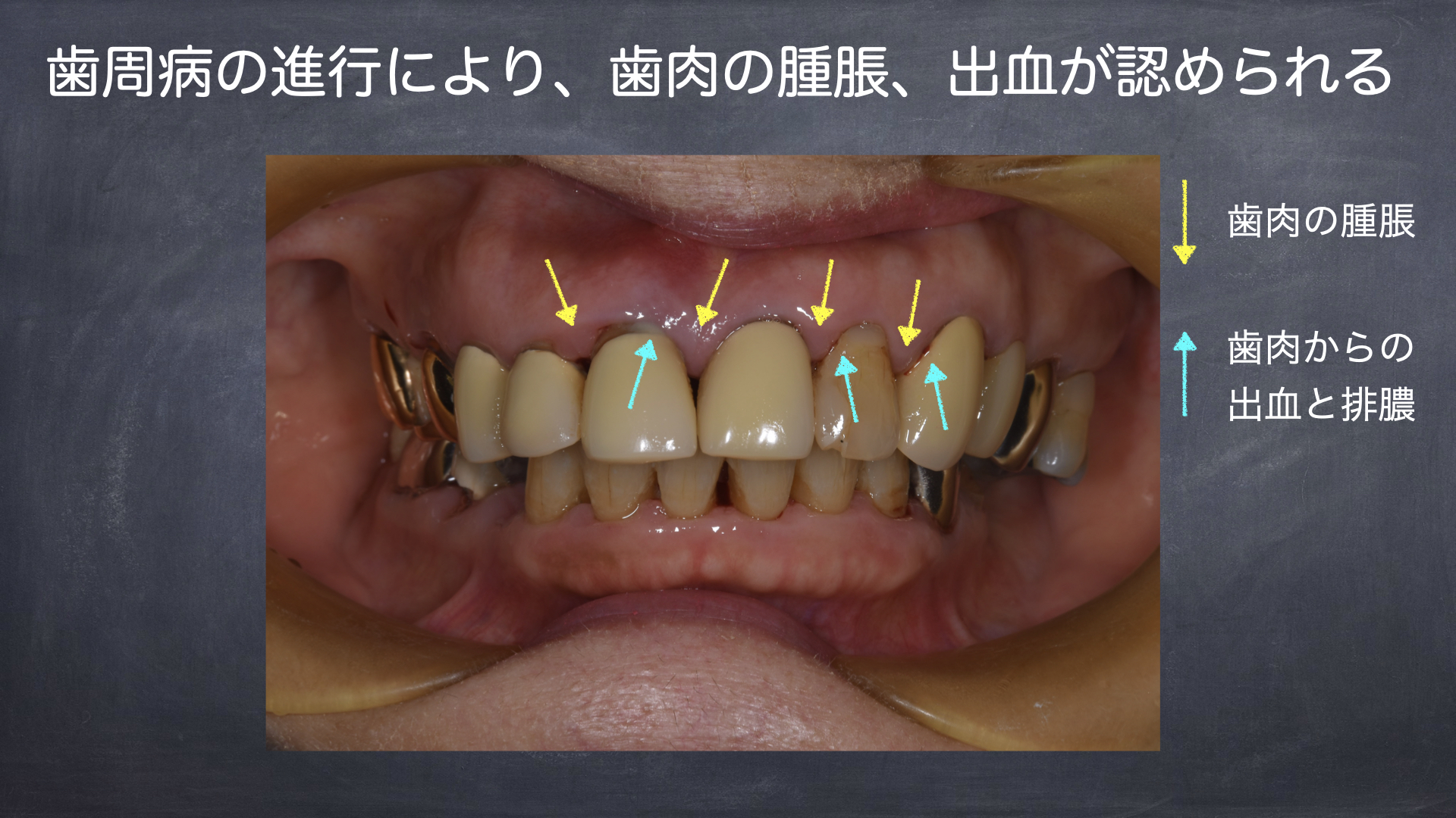 歯周病と歯肉退縮