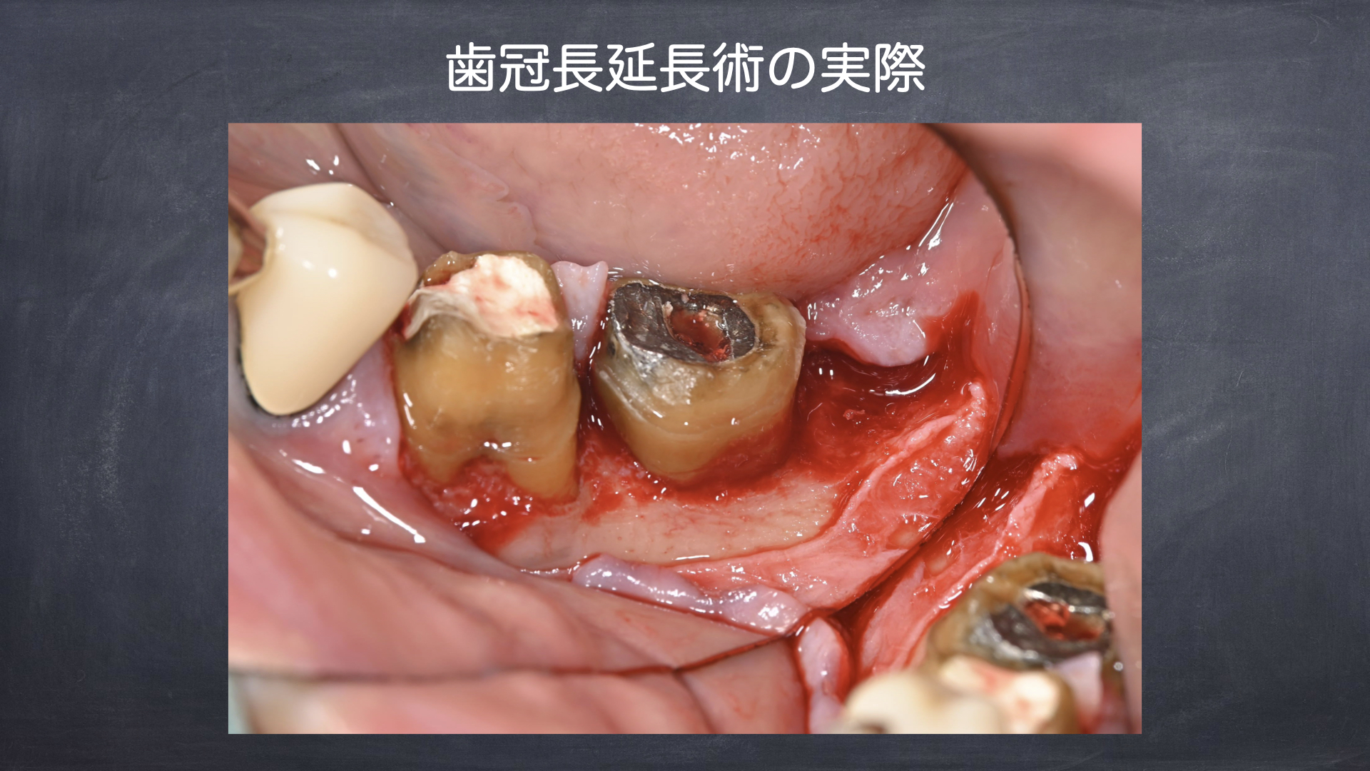 歯冠長延長術で適切な被せ物処置を行う