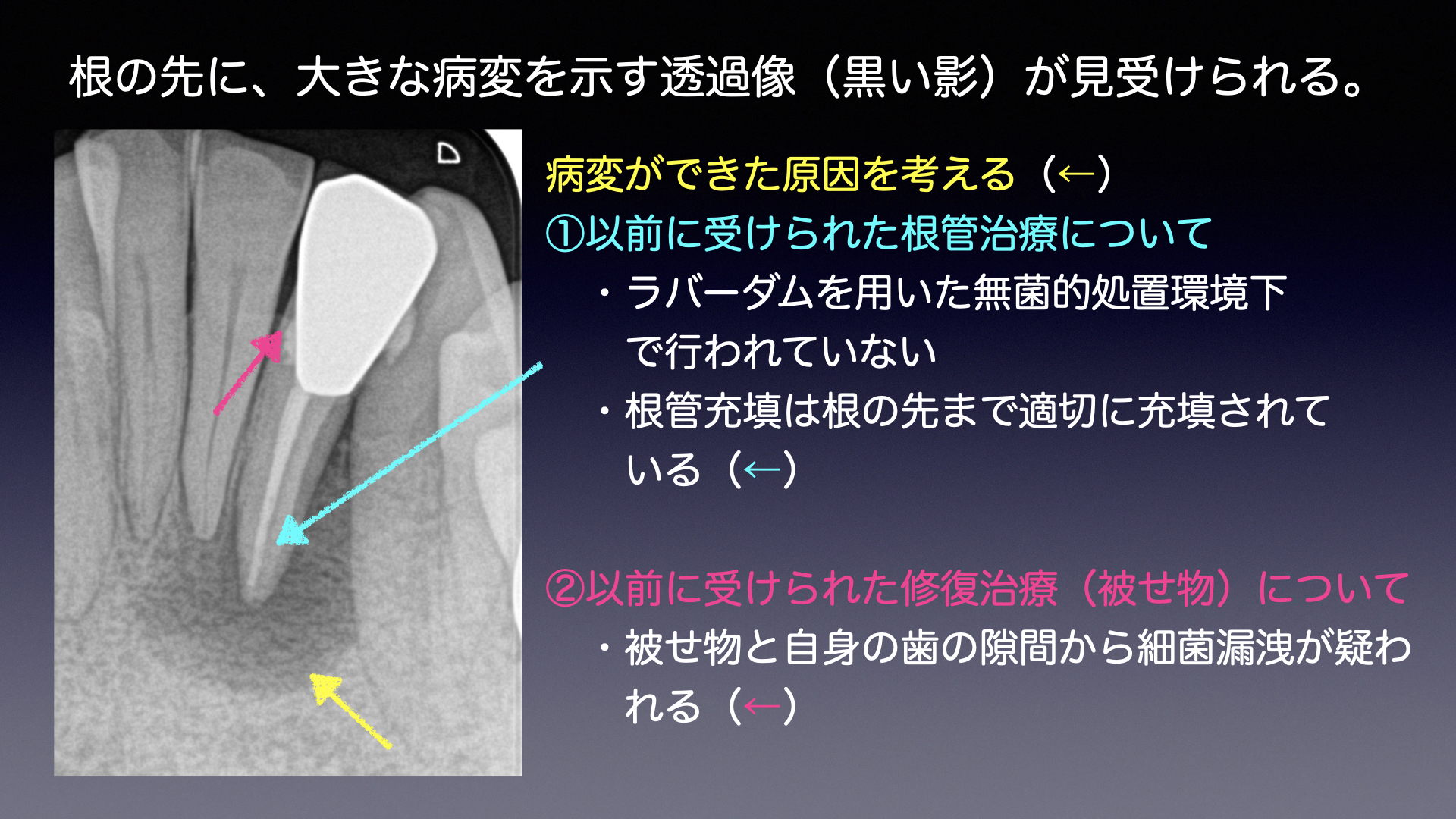 他院で根管治療したのに治らない症例への対応