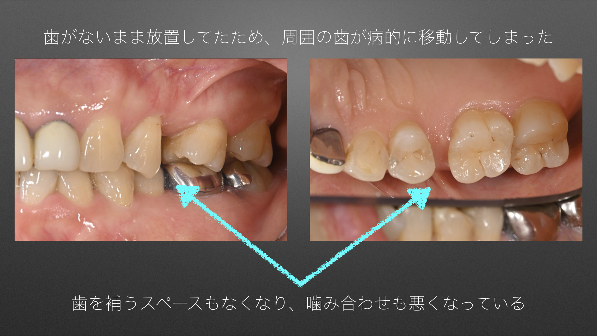 歯を失ったまま放置すると、どうなるか知っていますか？