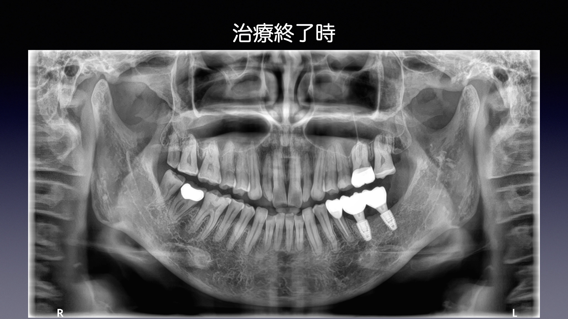 インプラント治療は「入れて終わり」ではありません–– 長持ちさせるために必要なこととは？ ––